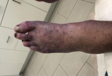 LaVar Ball foot amputation cause and medical details