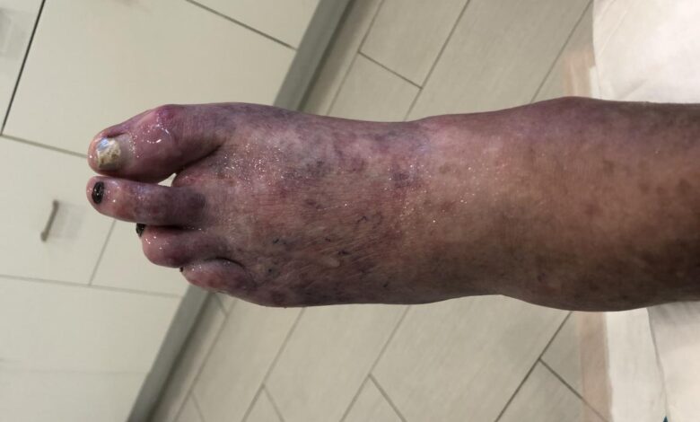 LaVar Ball foot amputation cause and medical details