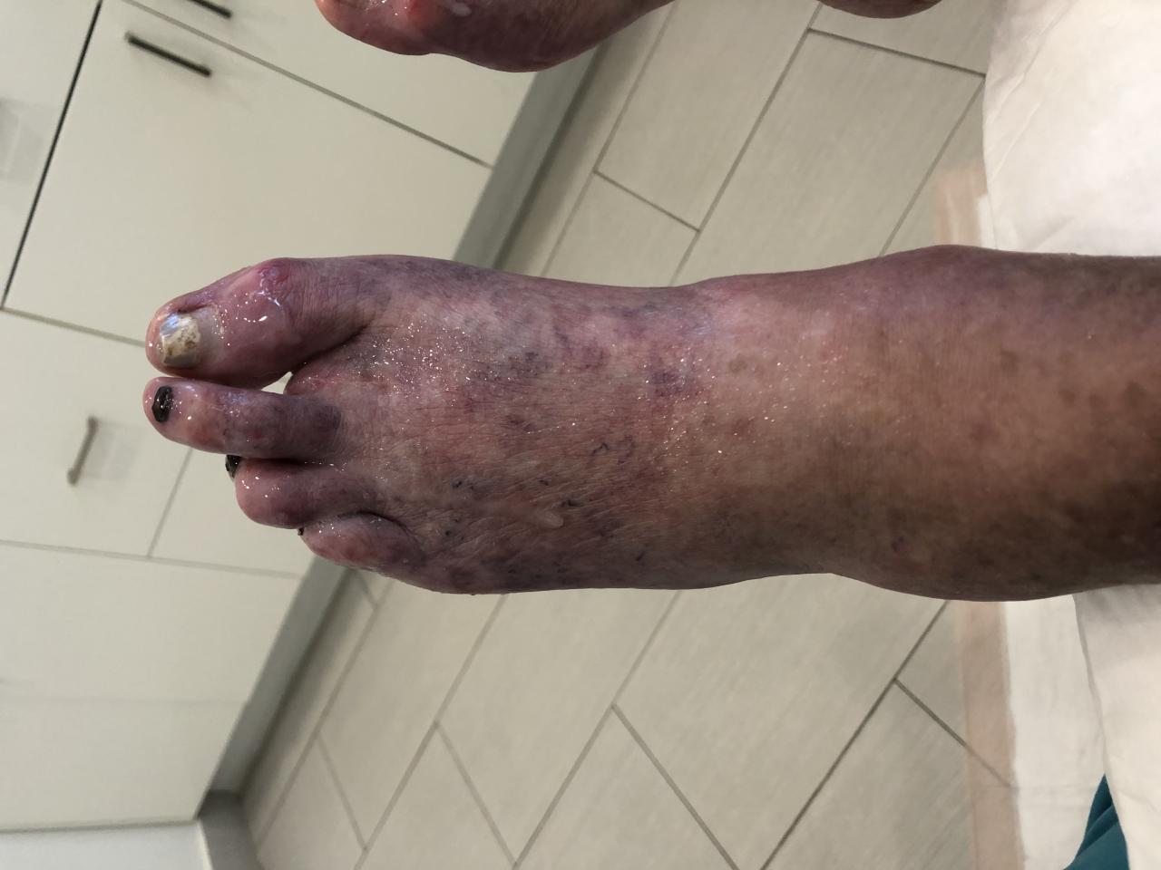 LaVar Ball foot amputation cause and medical details