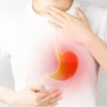 Understanding GERD: Chronic Digestive Disorder on the Rise, Affecting Younger Generations