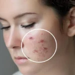 Not Just Skincare, These 5 Foods Effectively Help Overcome Acne