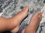 Beyond the Scale: Understanding Lipedema and Why Stubborn Fat in Legs May Not Be Your Fault