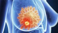 Understanding Breast Cancer Recovery: Can It Be Cured and Why Early Detection Matters Most